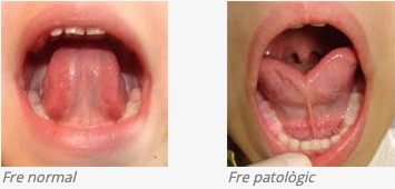 Fre labial curt normal i patològic