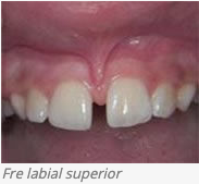 Fre labial superior