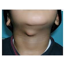 Tumoresbenignoscuello_Quiste-Tirogloso