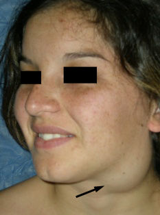 Tumoresbeningnoscuello_Quiste-branquial