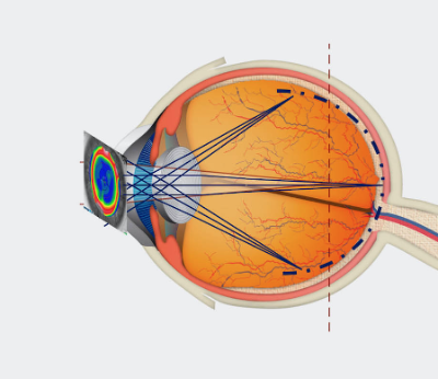 Acción óptica Ic Amiopik