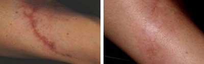 cicatriz-brazo