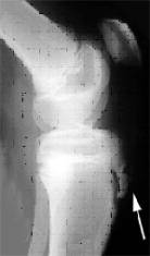 Enfermedad de Osgood Schlater