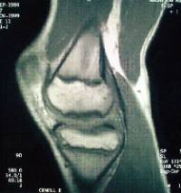 Osteocondritis disecante