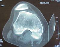 Inestabilidad fémoro patelar