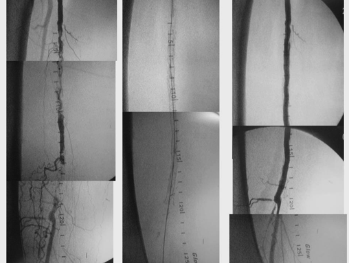 Recanalizacion endovascular compleja mediante Stent en paciente portador de by-pass distal