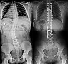Fusion de la columna vertebral