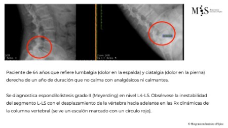 fusion endoscópica-update