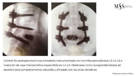 fusion endoscópica
