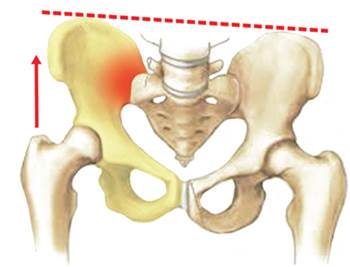 Sacroileitis (inflamación de la articulación sacroilíaca)