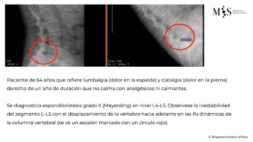 fusion endoscópica-update