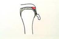 Acromion en gancho
