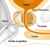 biopsia prostata_2