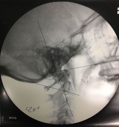 Occipitocervical fusion