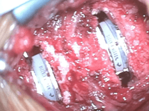 Hernia cervical 2