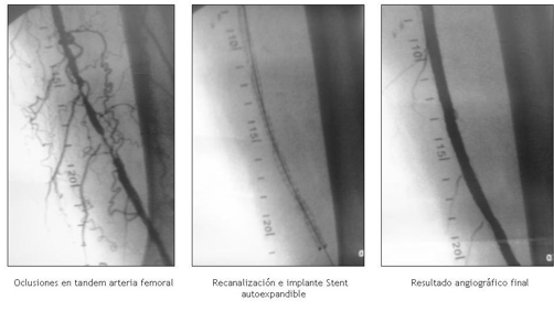 Recanalización femoral izquierda con Stent