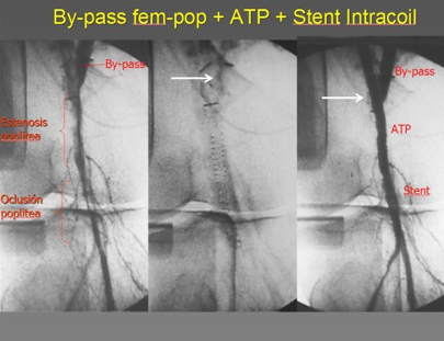 cirugia combinada convencional y endovascular revascularizar lesiones estenoticas