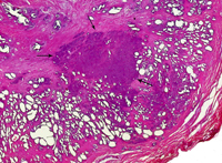 cancer de prostata_2