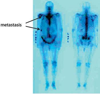 cancer_pros_pruebas_4