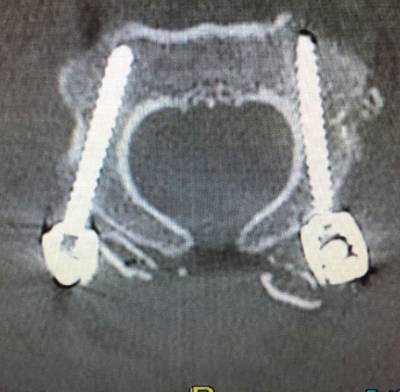 Atlantoaxial Instability Treatment 2