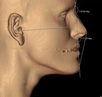 Planificación-3D-de-rinoplastia