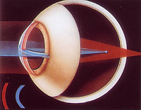 Astigmatismo