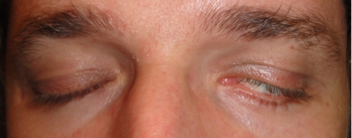parálisis facial