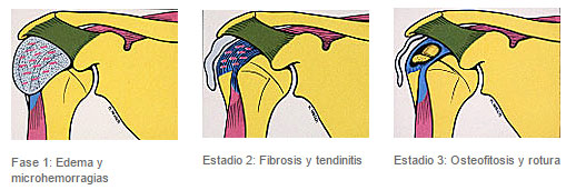 Fases del Síndrome subacromial