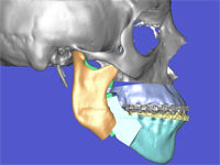 Técnica Surgery First2