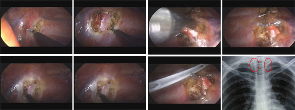 Técnica-de-colocación-de-clips-sin-seccionar-la-cadena-simpática