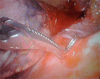 Retirada-de-clip-por-sudoración-compensadora-severa