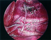 Técnica-de-reversibilidad-de-la-simpatectomia-con-interposición-de-un-nervi
