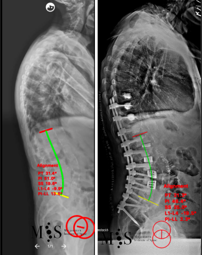 old-pre-vs-postop-LL