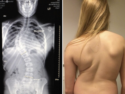 diagnotico de la escoliosis