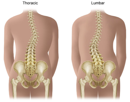 tipos de escoliosis