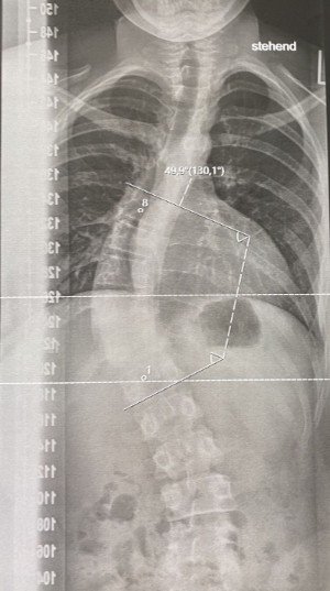 curva escoliotica con el ángulo de Cobb