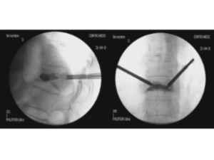 Ejemplo caso clínico cifoplastia 2