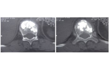 Ejemplo caso clínico cifoplastia 4