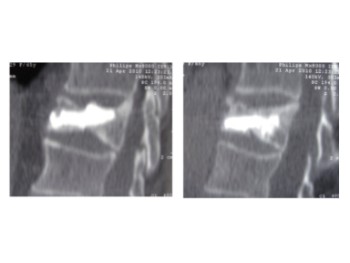Ejemplo caso clínico cifoplastia 5