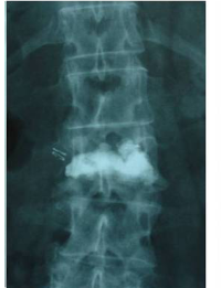 pre- y post-operatoria de una cifopastia cementada