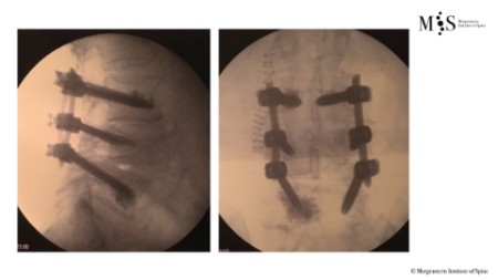 Caso clínico con estabilización percutánea de fractura vertebral inestable