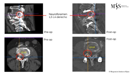 Caso clínico con estabilización percutánea de fractura vertebral inestable