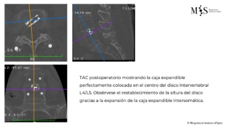 fusión endoscópica 3