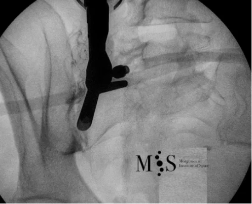 fluoroscopia intra-operatoria endoscopia sacroiliaca