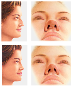 Rinoplastia Dr. Palacin