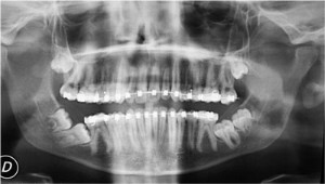 cirugia_bucal