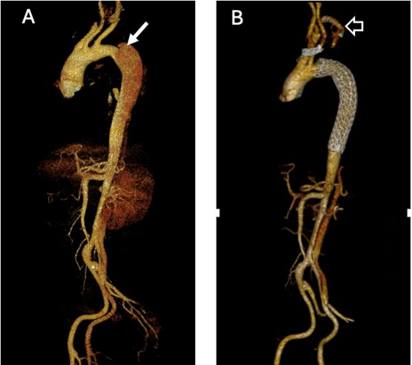Tratamiento diseccion aortica
