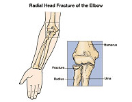 Fracturas de cabeza de radio