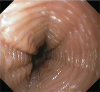 Esofagitis eosinfílica