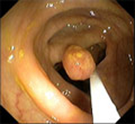 Pólipos de colon_3